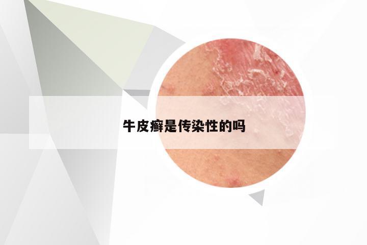 牛皮癣是传染性的吗