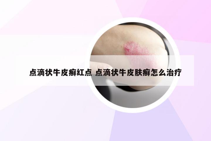 点滴状牛皮癣红点 点滴状牛皮肤癣怎么治疗