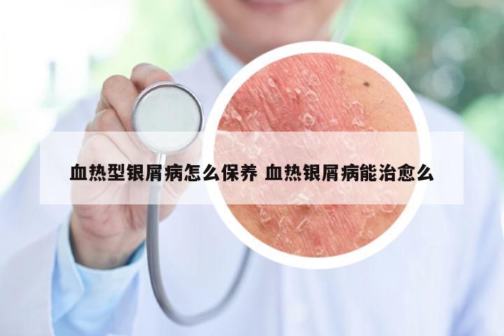 血热型银屑病怎么保养 血热银屑病能治愈么
