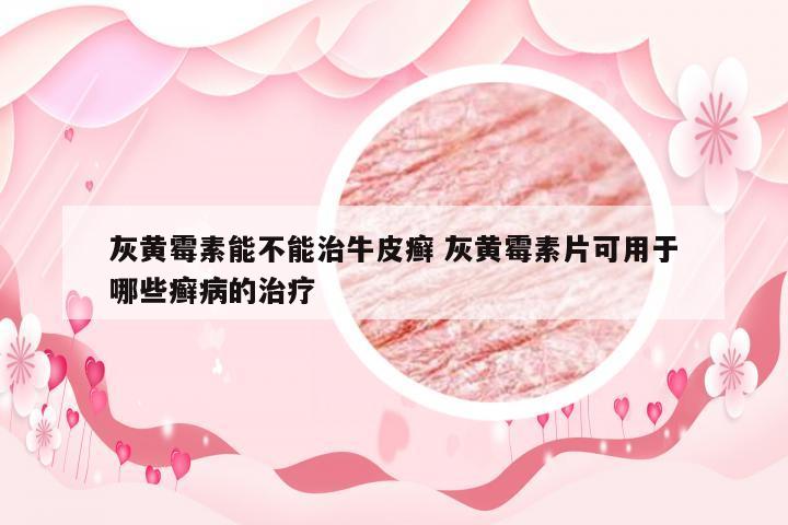 灰黄霉素能不能治牛皮癣 灰黄霉素片可用于哪些癣病的治疗