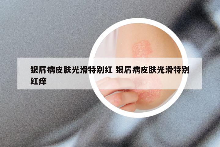银屑病皮肤光滑特别红 银屑病皮肤光滑特别红痒