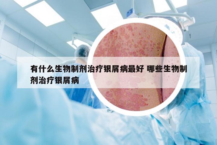 有什么生物制剂治疗银屑病最好 哪些生物制剂治疗银屑病