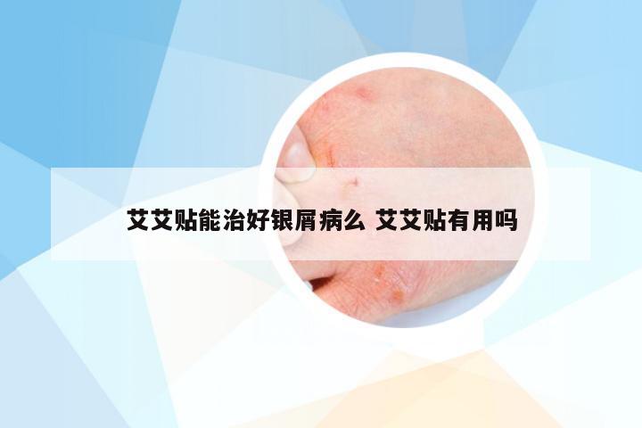 艾艾贴能治好银屑病么 艾艾贴有用吗