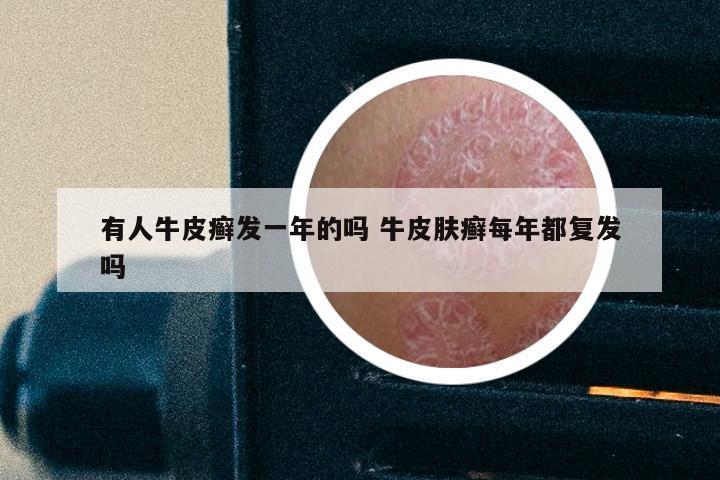 有人牛皮癣发一年的吗 牛皮肤癣每年都复发吗