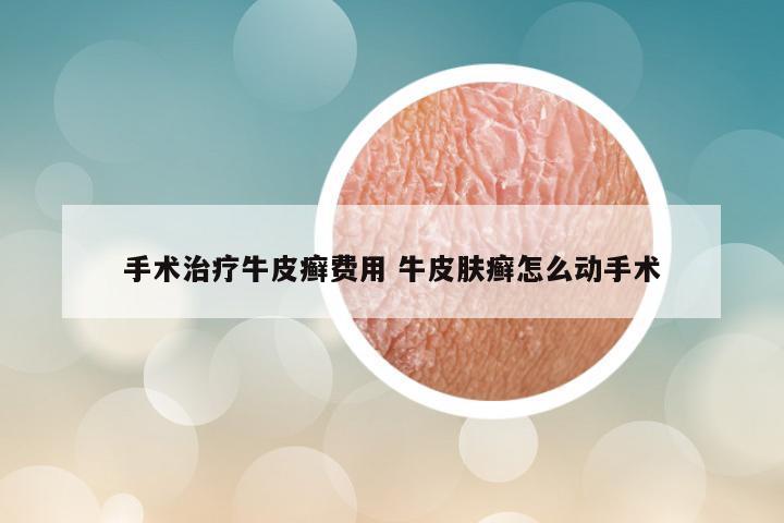 手术治疗牛皮癣费用 牛皮肤癣怎么动手术