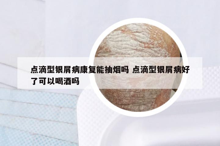 点滴型银屑病康复能抽烟吗 点滴型银屑病好了可以喝酒吗