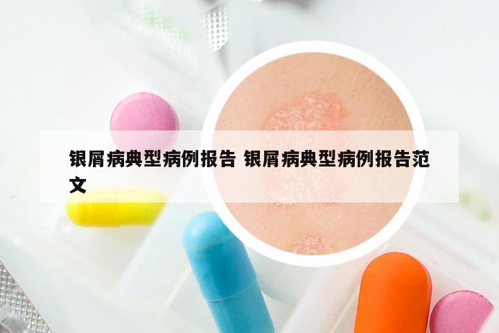 银屑病典型病例报告 银屑病典型病例报告范文