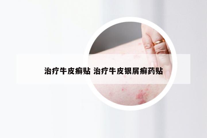 治疗牛皮癣贴 治疗牛皮银屑癣药贴