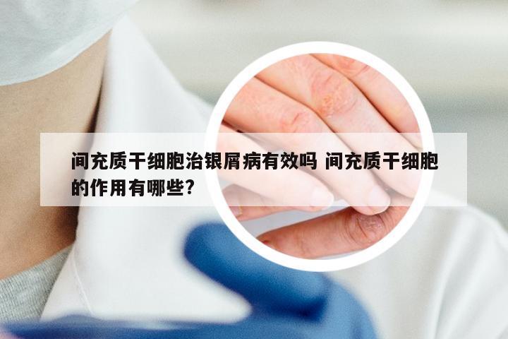 间充质干细胞治银屑病有效吗 间充质干细胞的作用有哪些?