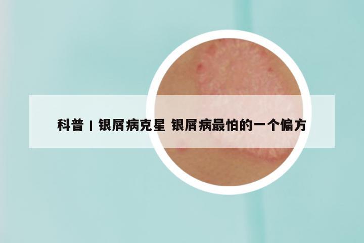 科普丨银屑病克星 银屑病最怕的一个偏方