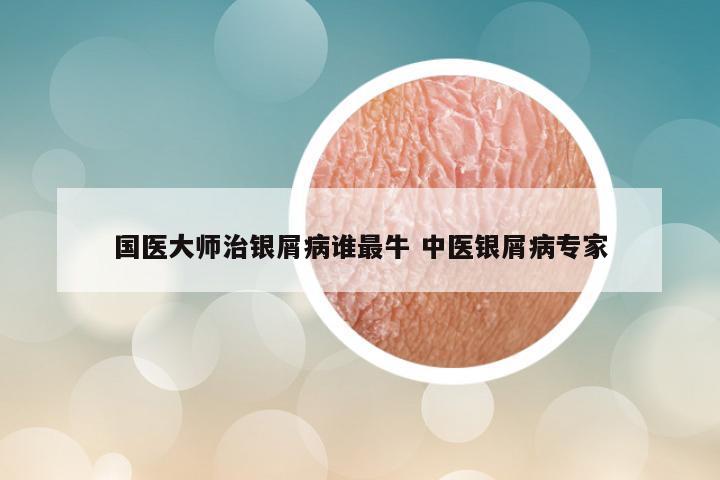 国医大师治银屑病谁最牛 中医银屑病专家