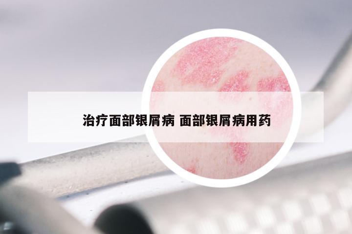 治疗面部银屑病 面部银屑病用药