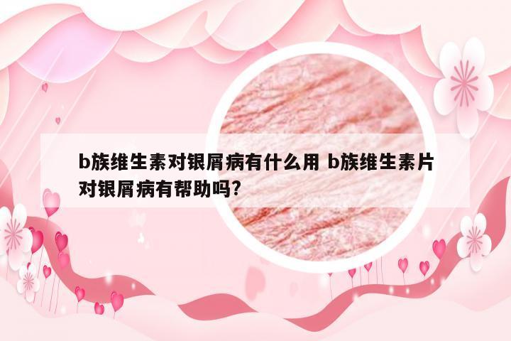 b族维生素对银屑病有什么用 b族维生素片对银屑病有帮助吗?
