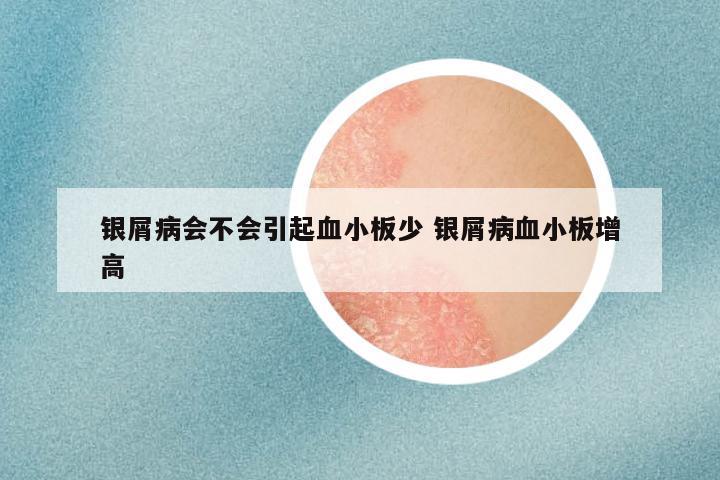 银屑病会不会引起血小板少 银屑病血小板增高