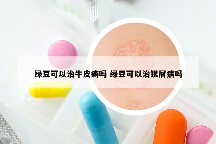 绿豆可以治牛皮癣吗 绿豆可以治银屑病吗
