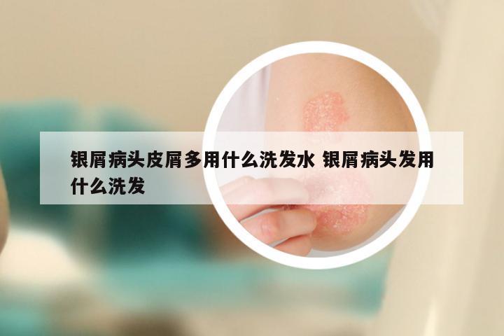 银屑病头皮屑多用什么洗发水 银屑病头发用什么洗发