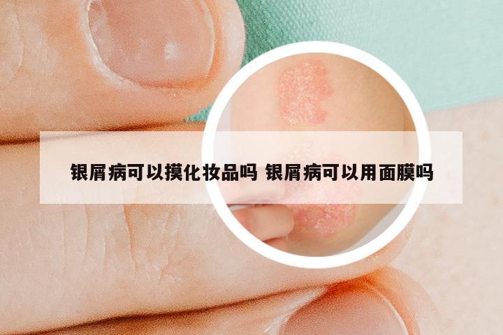 银屑病可以摸化妆品吗 银屑病可以用面膜吗