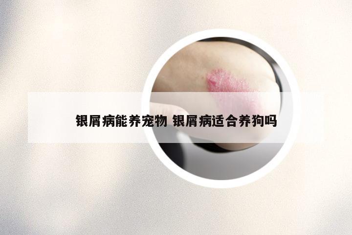 银屑病能养宠物 银屑病适合养狗吗