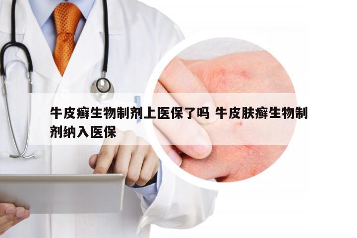 牛皮癣生物制剂上医保了吗 牛皮肤癣生物制剂纳入医保