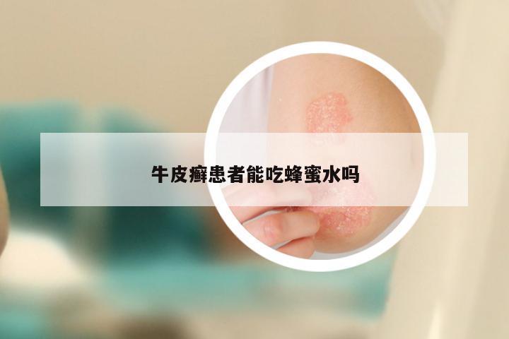 牛皮癣患者能吃蜂蜜水吗