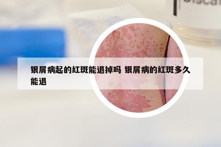 银屑病起的红斑能退掉吗 银屑病的红斑多久能退