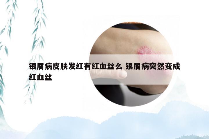 银屑病皮肤发红有红血丝么 银屑病突然变成红血丝