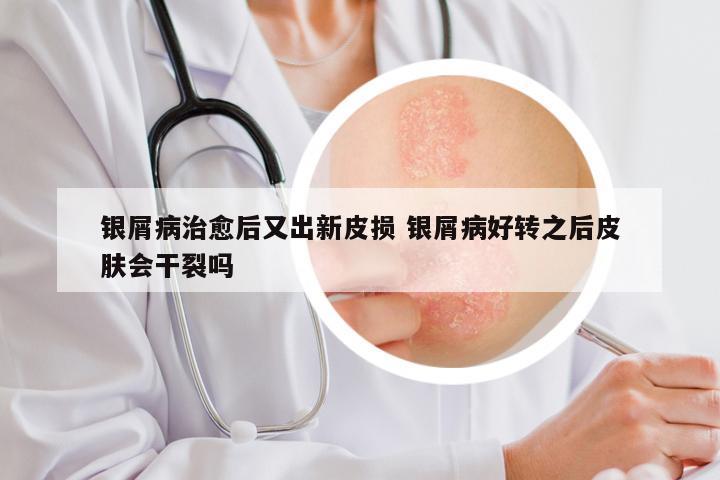 银屑病治愈后又出新皮损 银屑病好转之后皮肤会干裂吗