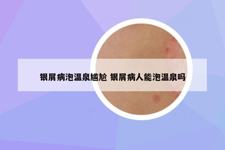 银屑病泡温泉尴尬 银屑病人能泡温泉吗