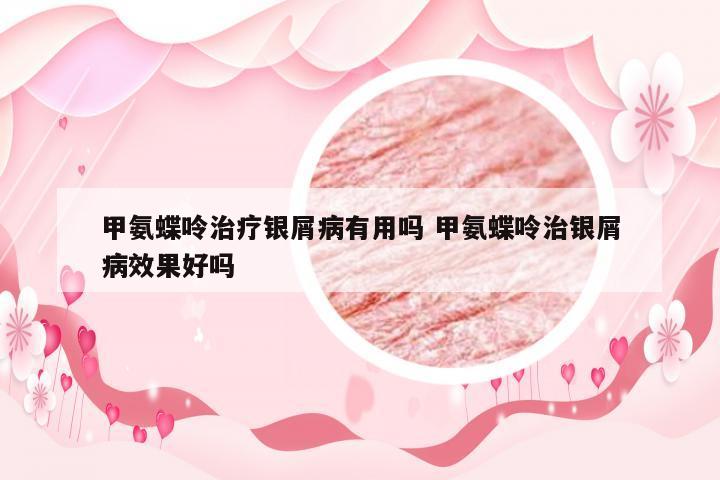 甲氨蝶呤治疗银屑病有用吗 甲氨蝶呤治银屑病效果好吗