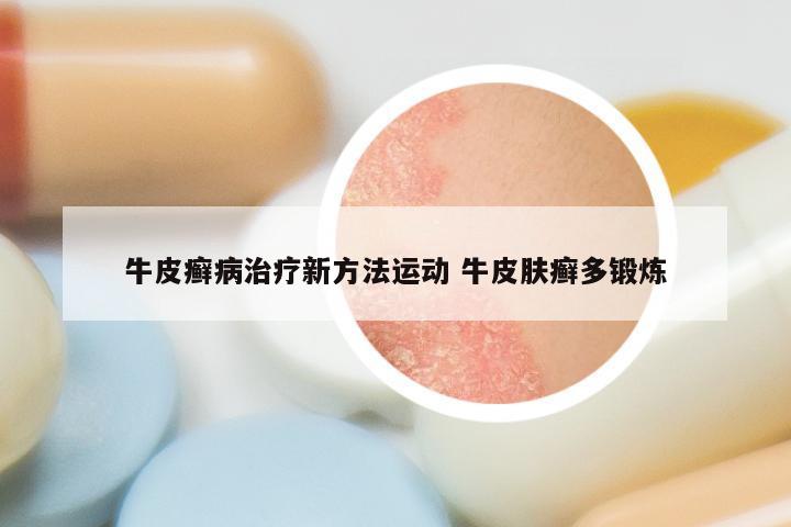 牛皮癣病治疗新方法运动 牛皮肤癣多锻炼