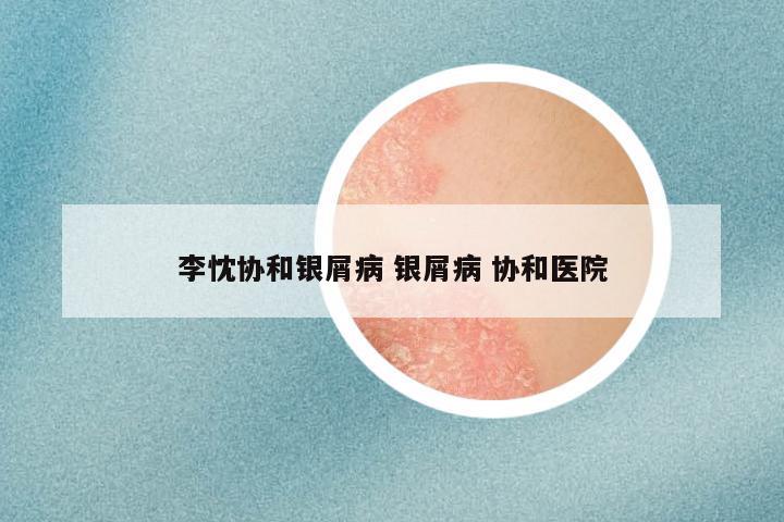 李忱协和银屑病 银屑病 协和医院