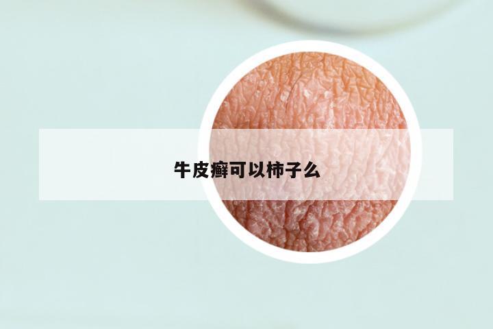 牛皮癣可以柿子么