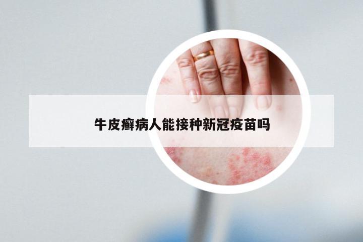 牛皮癣病人能接种新冠疫苗吗