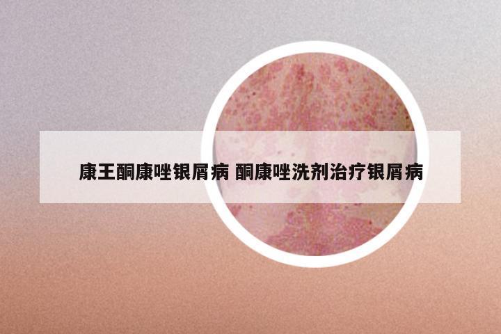 康王酮康唑银屑病 酮康唑洗剂治疗银屑病