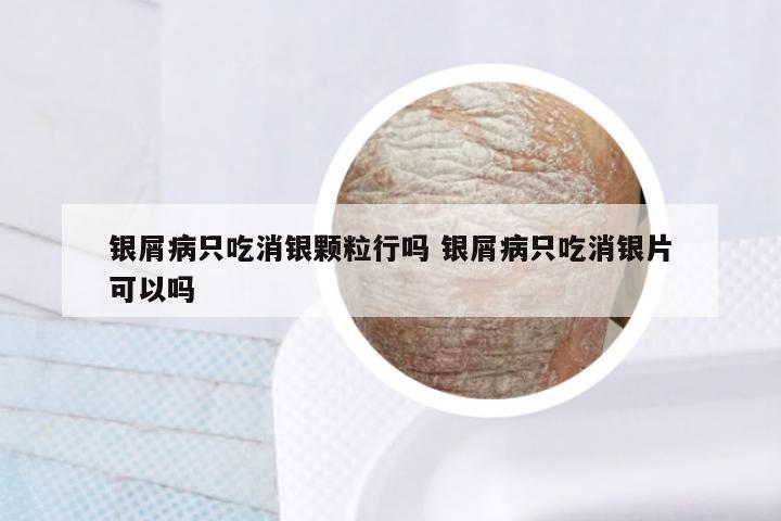 银屑病只吃消银颗粒行吗 银屑病只吃消银片可以吗