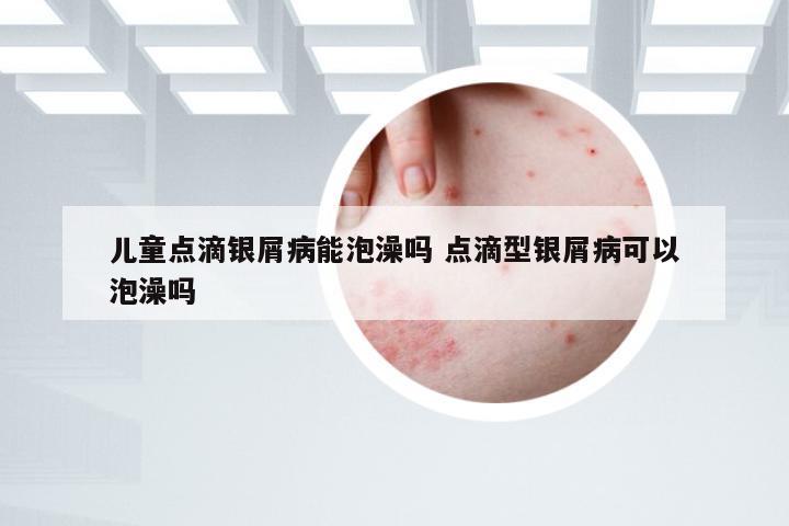 儿童点滴银屑病能泡澡吗 点滴型银屑病可以泡澡吗