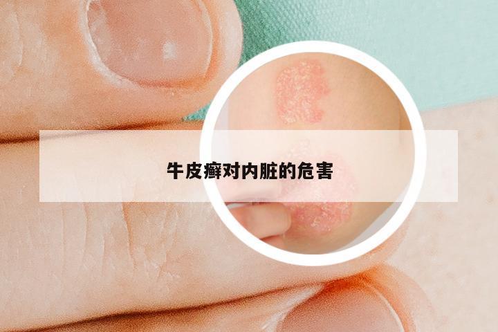 牛皮癣对内脏的危害
