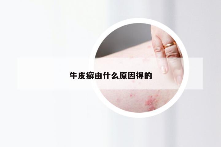 牛皮癣由什么原因得的