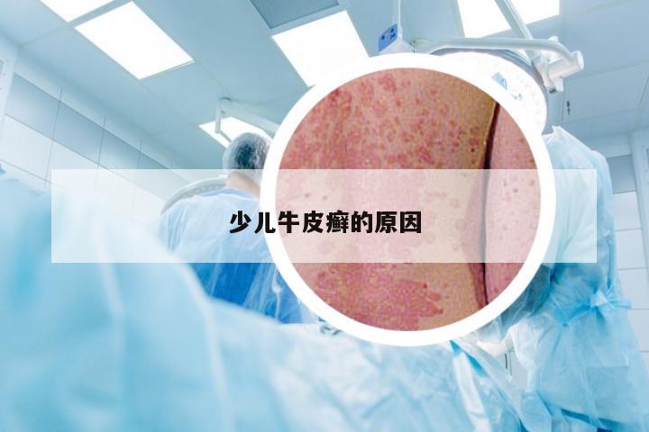 少儿牛皮癣的原因
