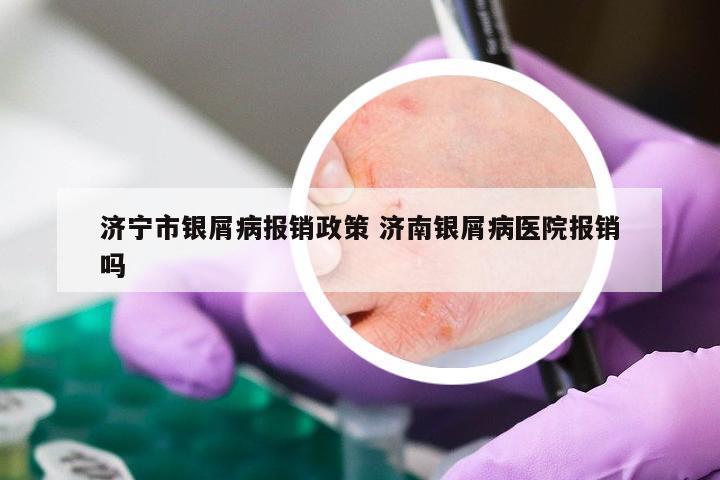 济宁市银屑病报销政策 济南银屑病医院报销吗