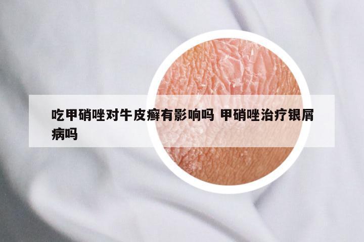 吃甲硝唑对牛皮癣有影响吗 甲硝唑治疗银屑病吗