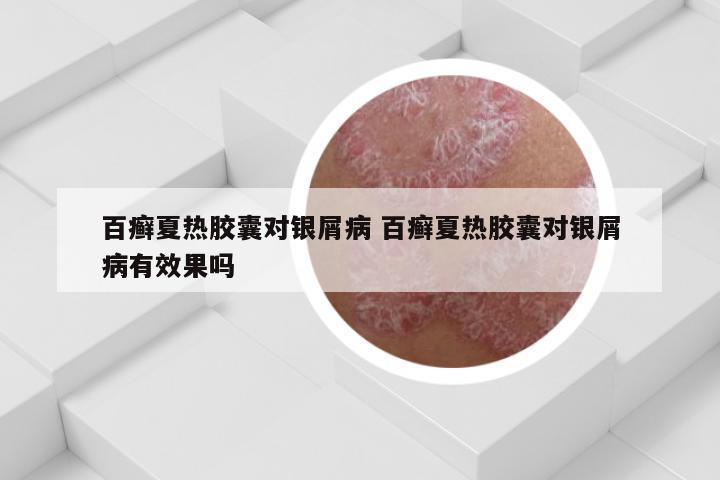 百癣夏热胶囊对银屑病 百癣夏热胶囊对银屑病有效果吗