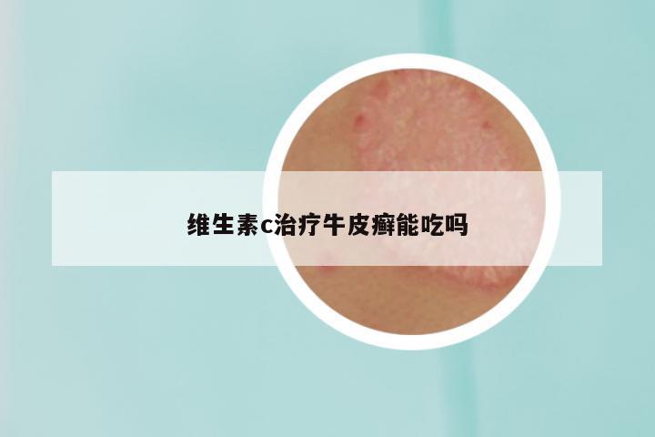 维生素c治疗牛皮癣能吃吗