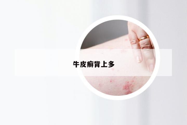 牛皮癣背上多