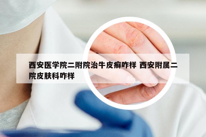 西安医学院二附院治牛皮癣咋样 西安附属二院皮肤科咋样