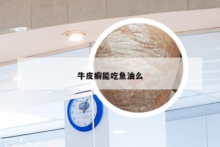 牛皮癣能吃鱼油么