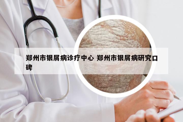 郑州市银屑病诊疗中心 郑州市银屑病研究口碑