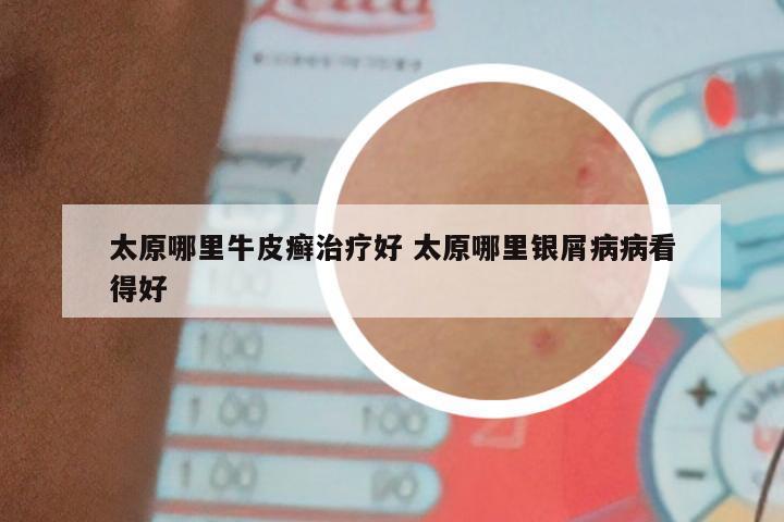 太原哪里牛皮癣治疗好 太原哪里银屑病病看得好
