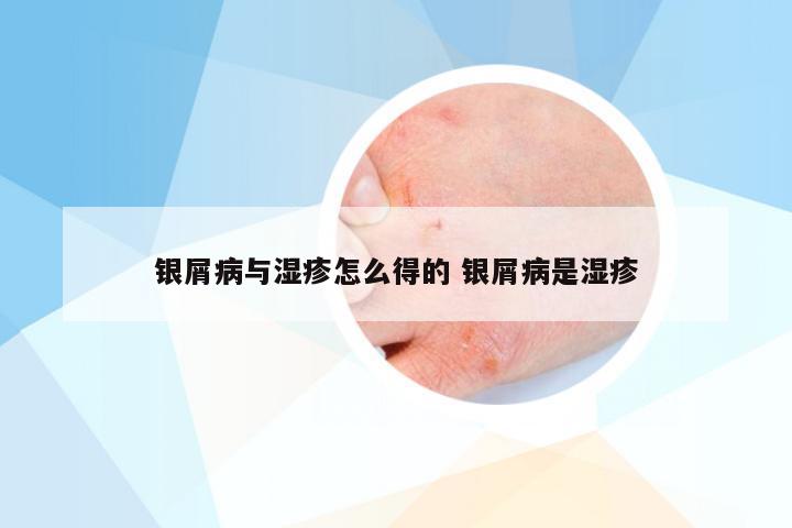 银屑病与湿疹怎么得的 银屑病是湿疹