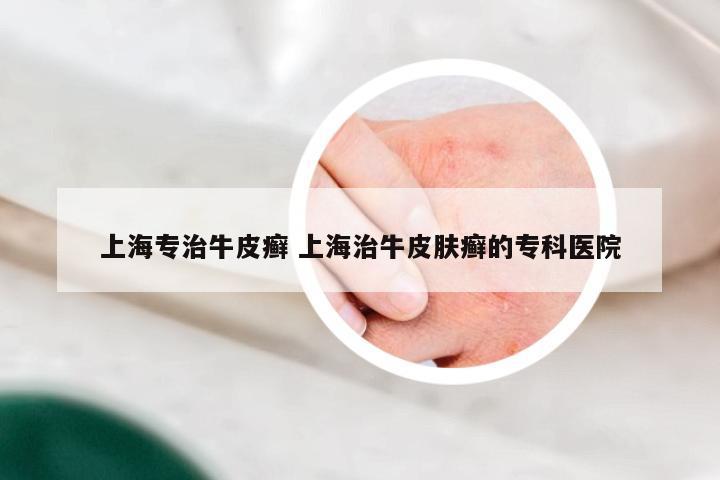上海专治牛皮癣 上海治牛皮肤癣的专科医院